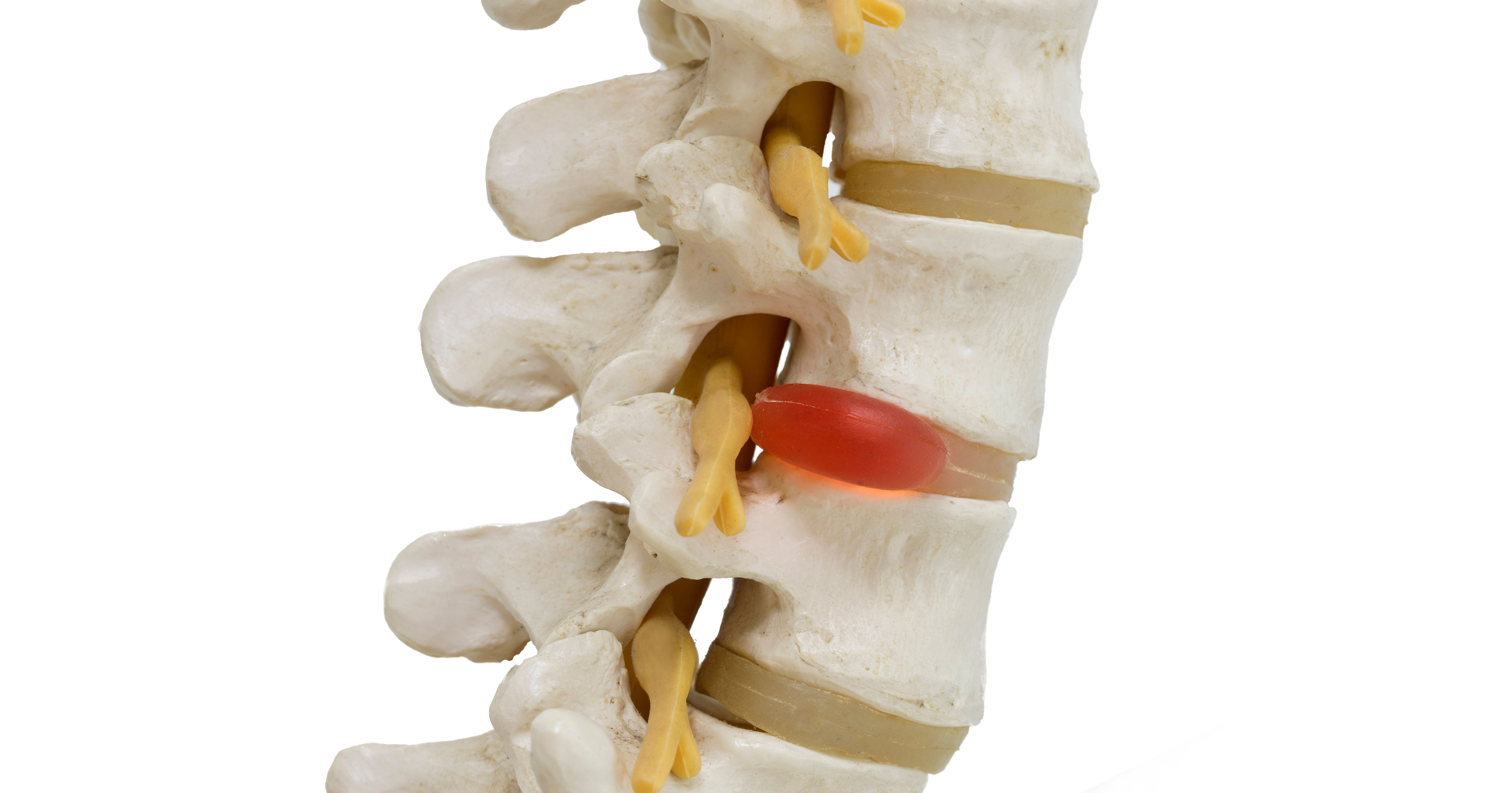 Close-up view of herniated lumbar vertebral disc m