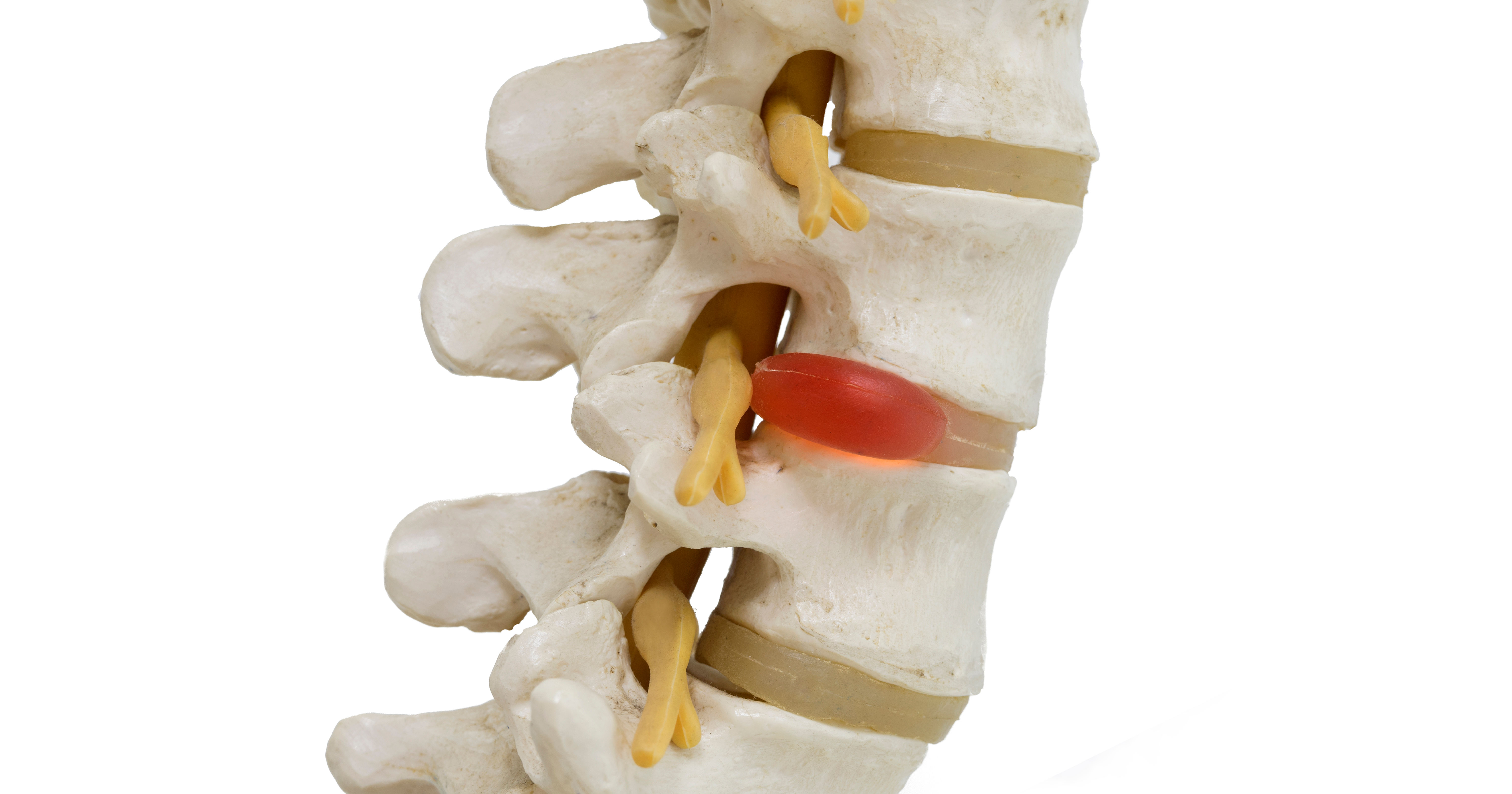 Close-up view of herniated lumbar vertebral disc m