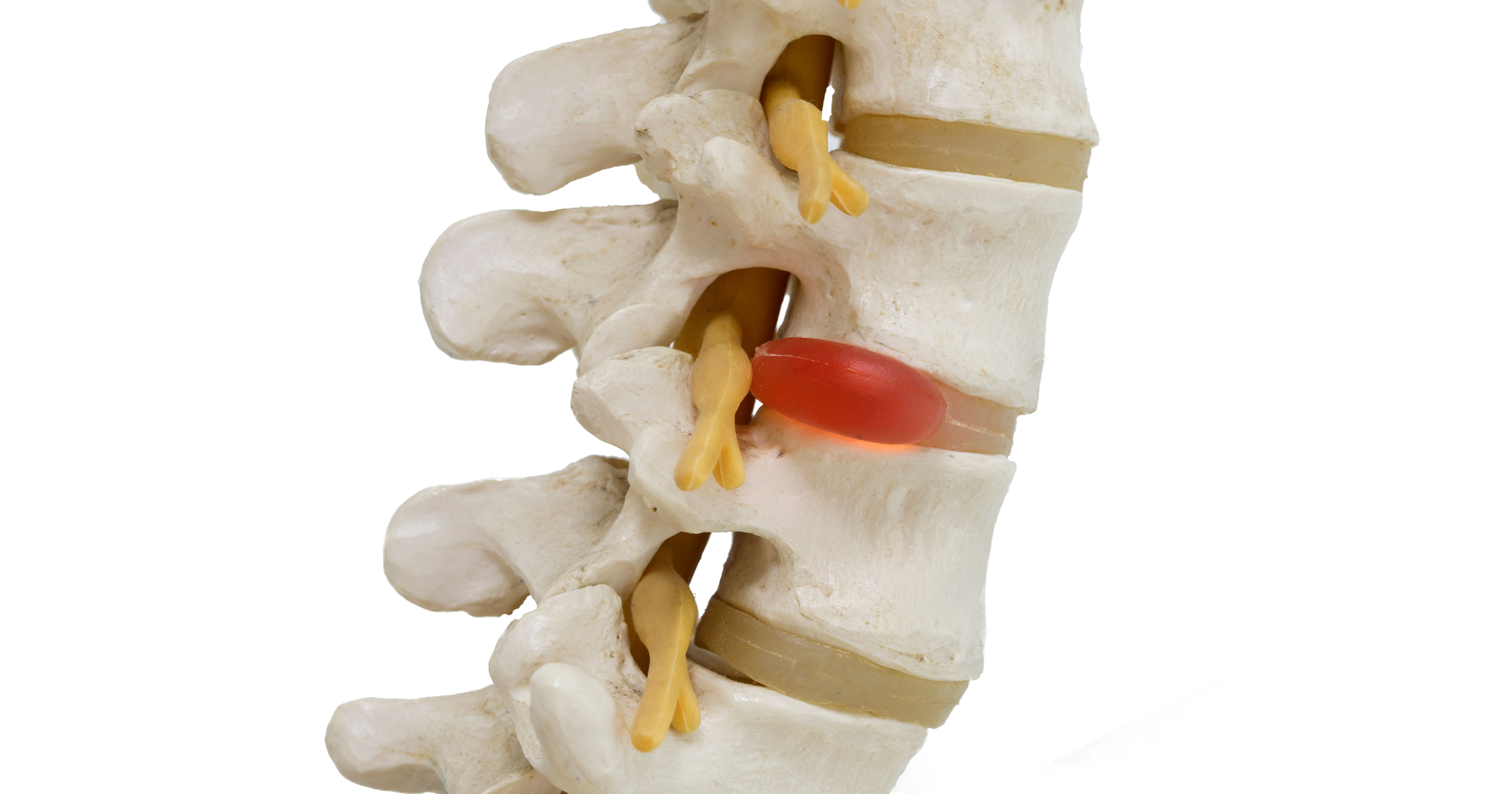 Close-up view of herniated lumbar vertebral disc m
