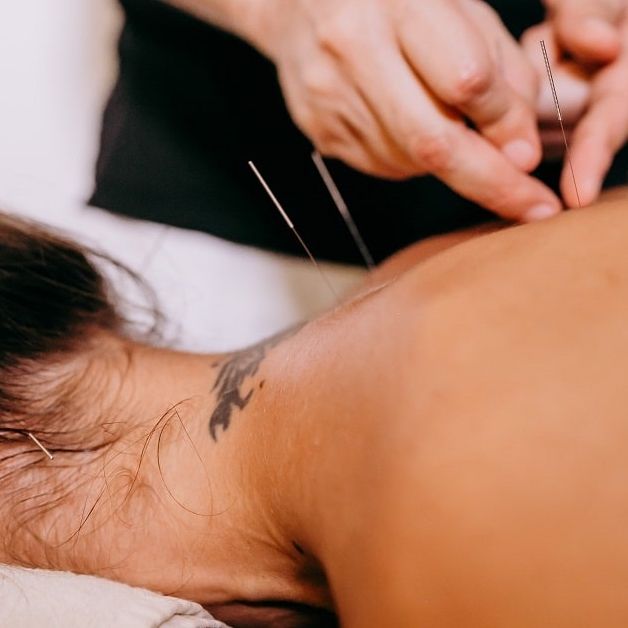  dry-needling-faqs-youve-been-asking-answered