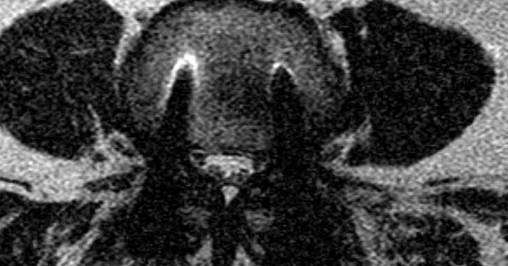 Lumbar Spine Fusion Chiropractor