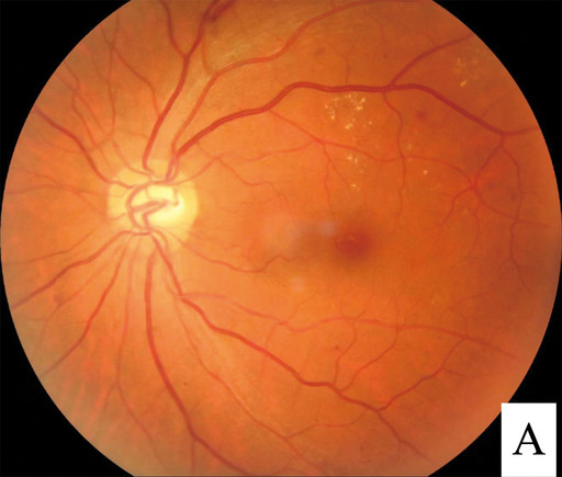 Diabetic retinopathy