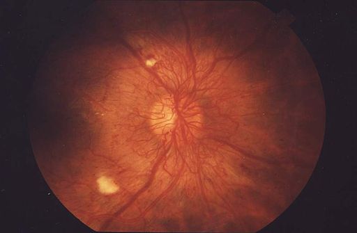 Diabetic retinopathy- proliferative