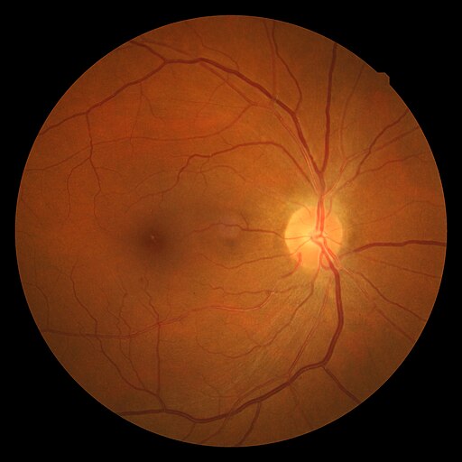 Hypertensive retinopathy- AV nicking and vascular tortuosity