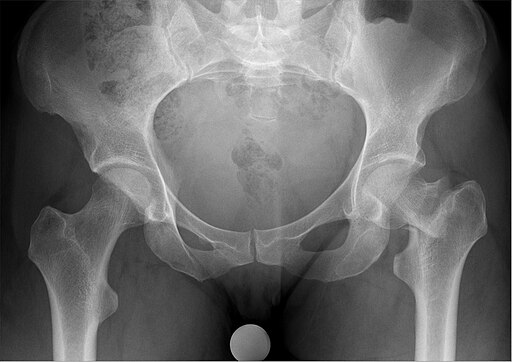 XR pelvis- Left intracapsular neck of femur fracture