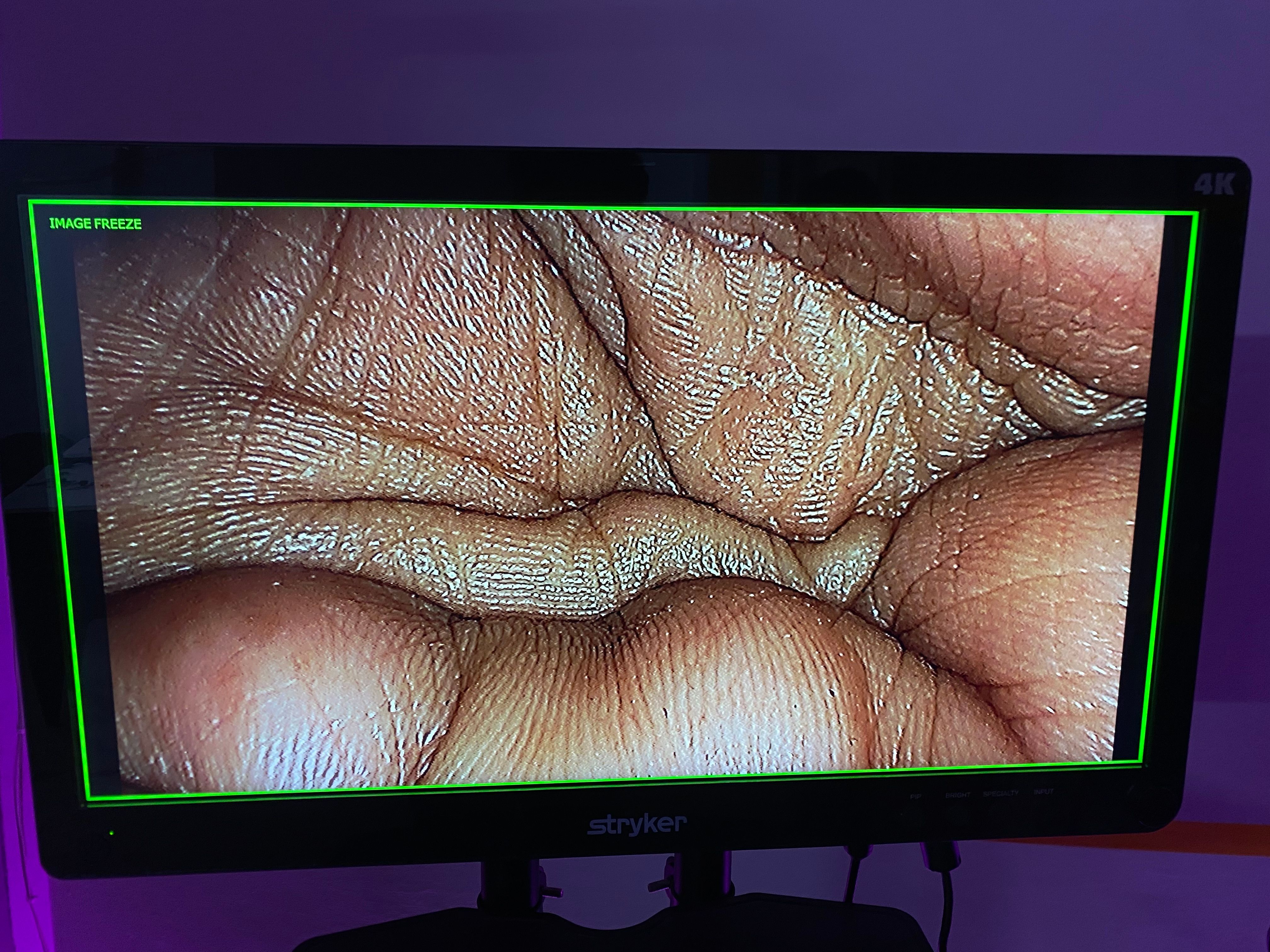Stryker 1588 laparoscopy tower system connected to an ultra high definition surgical medical display matrix