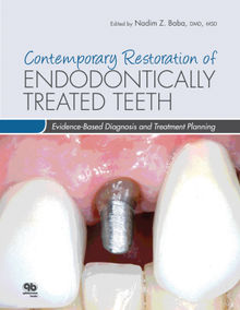 Contemporary Restoration of Endodontically Treated Teeth