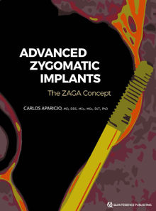 Zygomatic Implants