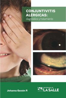 Conjuntivitis alrgicas