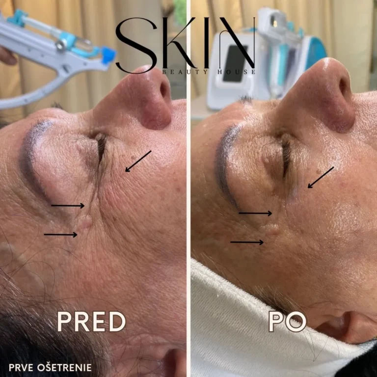 shape before and after mesotherapy