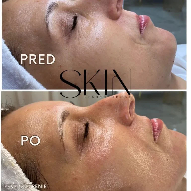 shape before and after mesotherapy