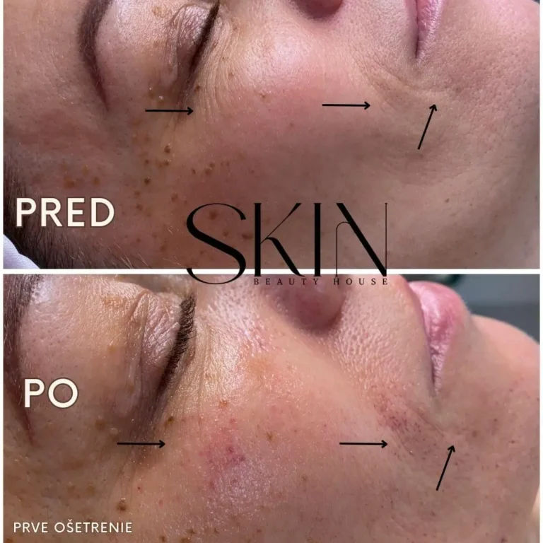 shape before and after mesotherapy