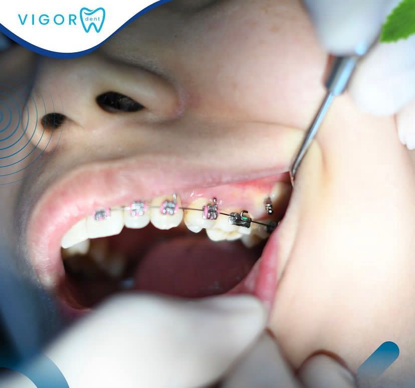 Vigordent - Image 2