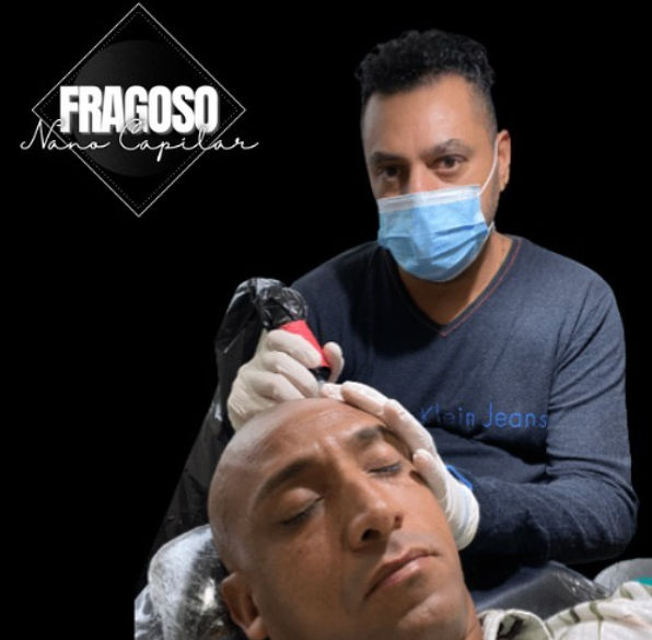 Fragozo Scalp - Micropigmentação - Image 2