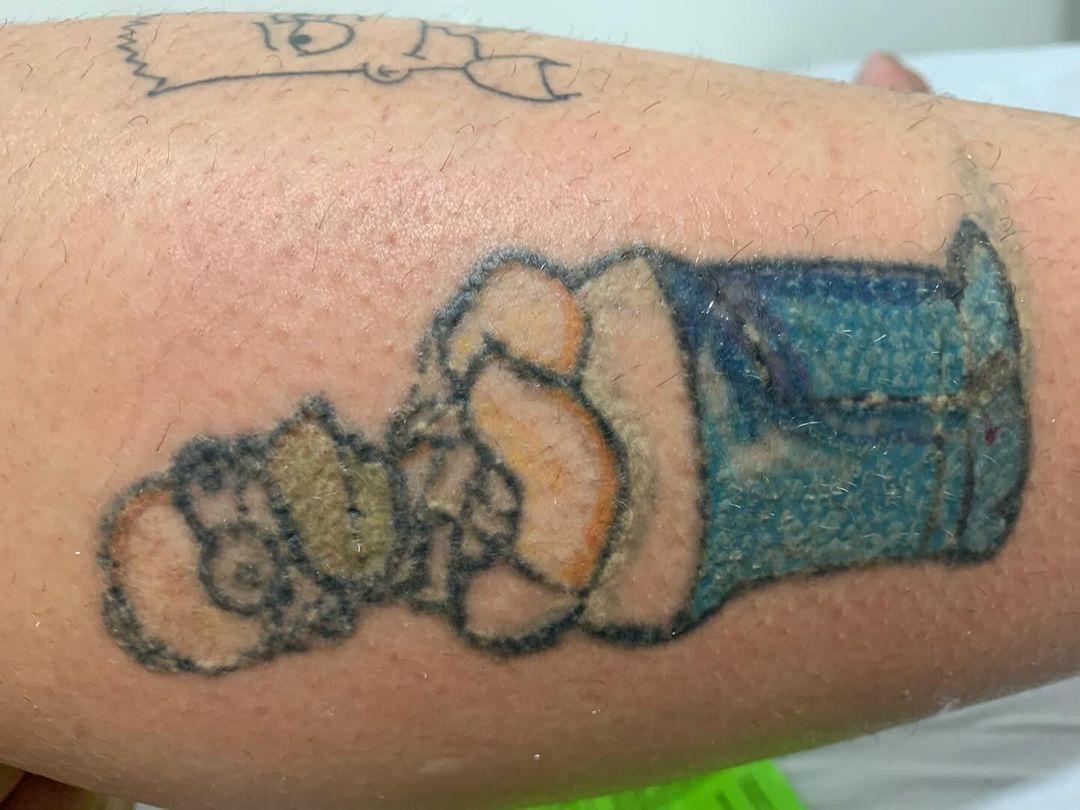 Marcelo Jardim - Remoção de Tatuagem e Micropigmentação - Image 7