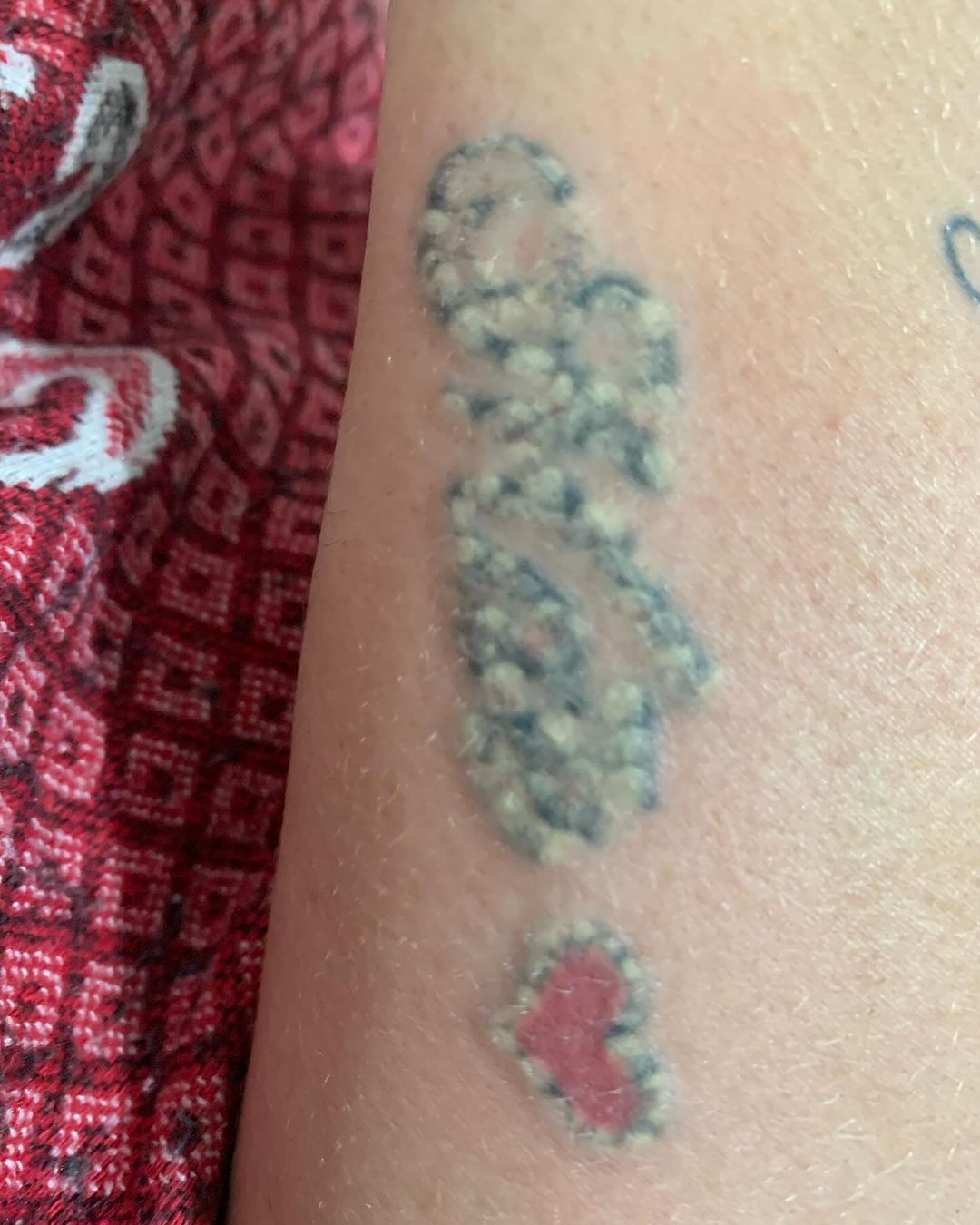 Marcelo Jardim - Remoção de Tatuagem e Micropigmentação - Image 2