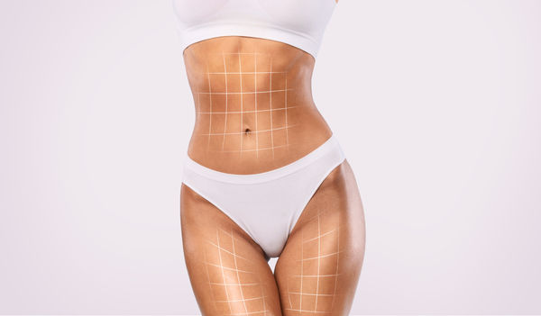 Lipocavitação