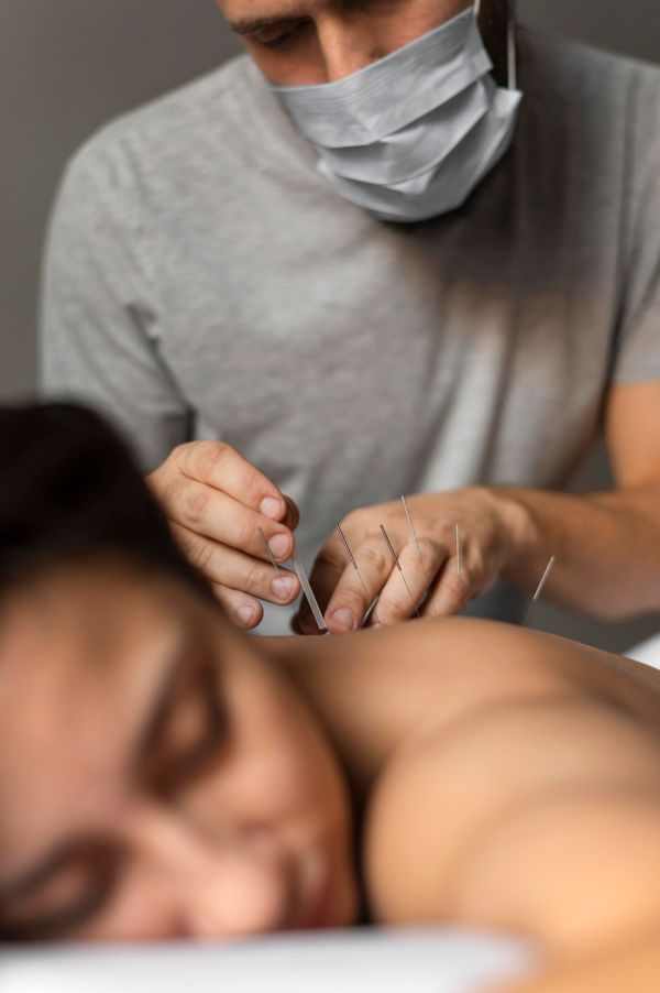 Acupuntura