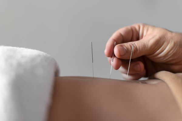 Acupuntura