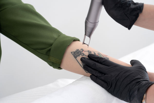 Remoção a laser de Tatuagem