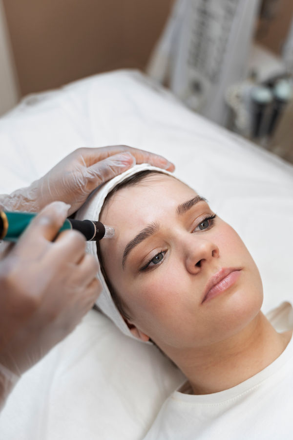 Microagulhamento Facial