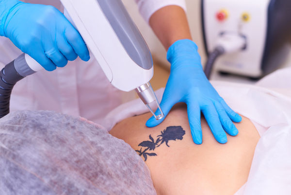 Remoção de Tatuagem a Laser – Avaliação Gratuita