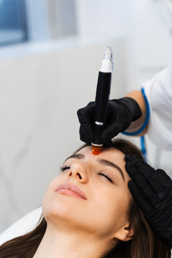 Despigmentação de Micropigmentação a Laser – Sessão