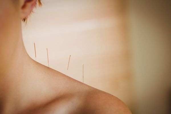 Acupuntura