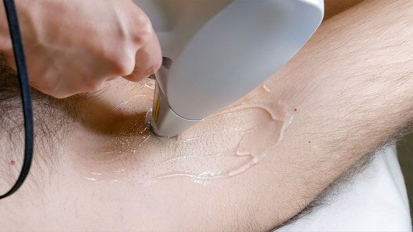 Axilas- Depilação a Laser Homem