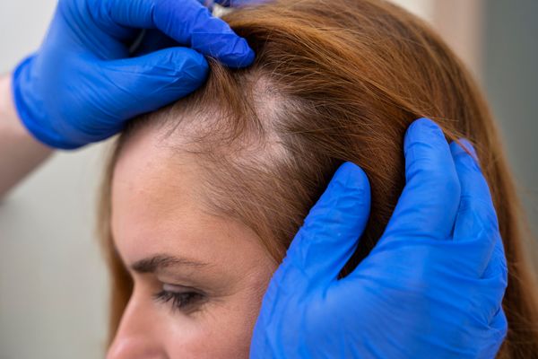 Rejuvenescimento Capilar