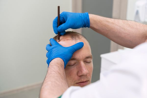 Pacote de Micropigmentação Capilar Masculina - 3 Sessões