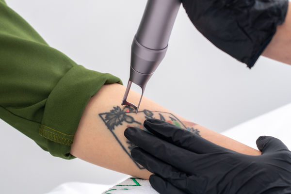 Remoção de Tatuagem - Até 5cm