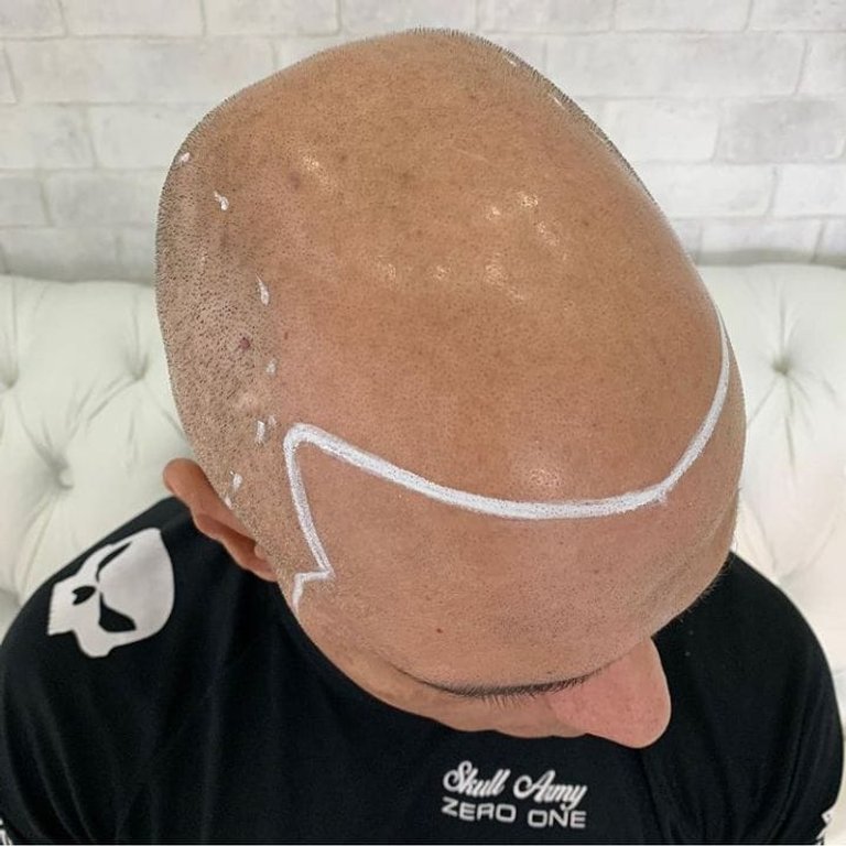 Royal Micropigmentação Capilar