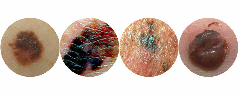 Image of melanoma 