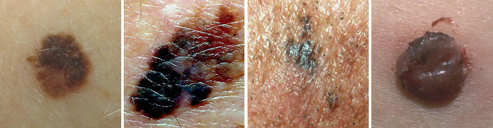 superficial spreading malignant melanoma