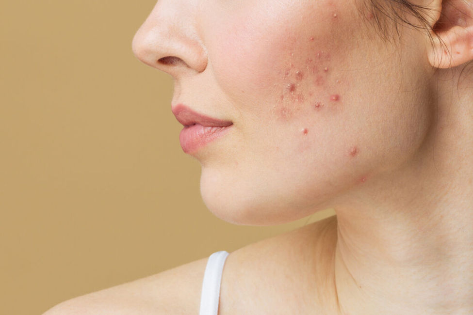 Acne Treatment in Kalyan