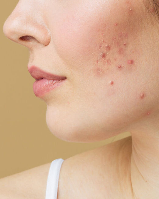 Acne Treatment in Kalyan