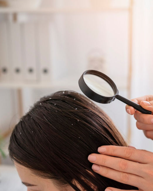 Best Dandruff Treatment in Kalyan