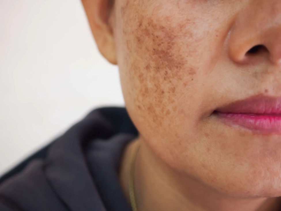 Pigmentation Treatment in Kalyan