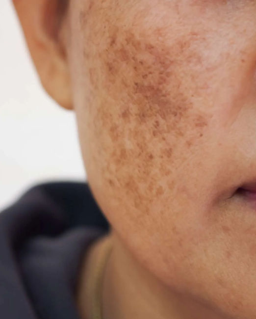 Pigmentation Treatment in Kalyan