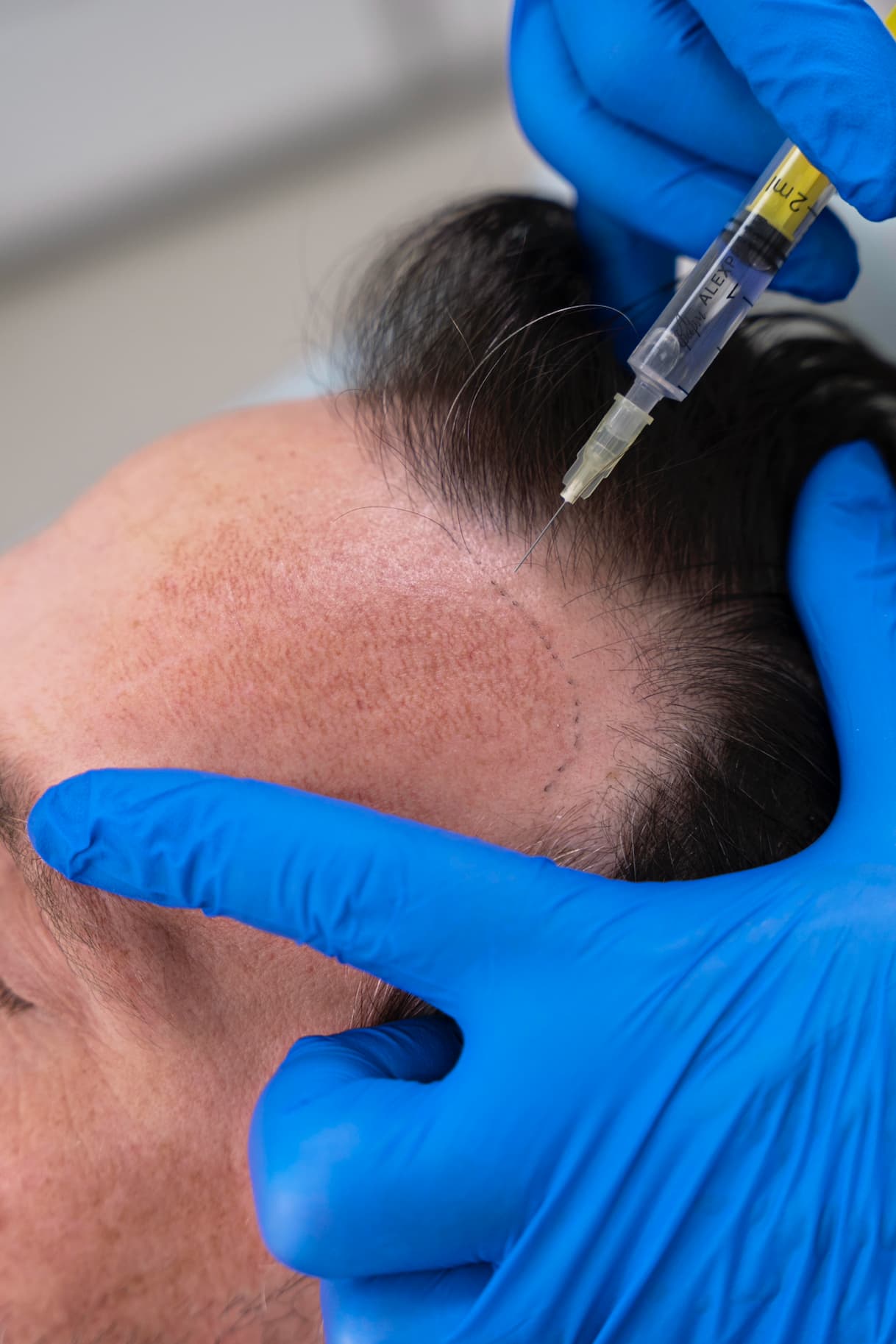 what is hair regrowth