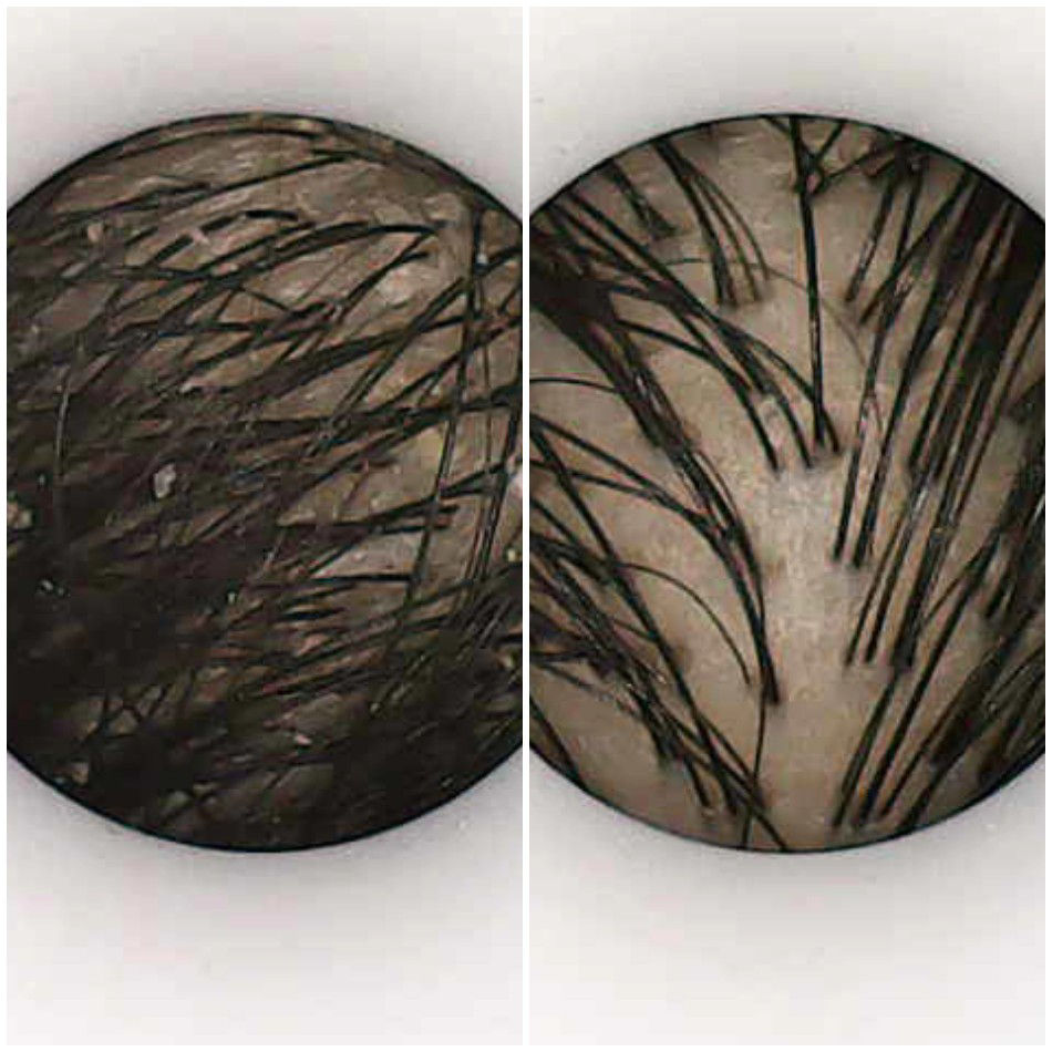 dandruff before after at Myskindom