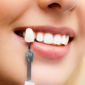 Diş Kaplama Çeşitleri Nelerdir?