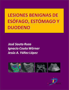 Lesiones benignas de esofgo, estmago y duodeno.  Jess A. Yez Lpez