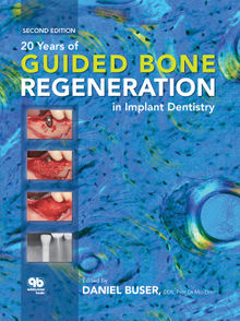 20 Years of Guided Bone Regeneration in Implant Dentistry.  Daniel Buser