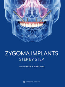 Zygoma Implants.  Arun K. Garg