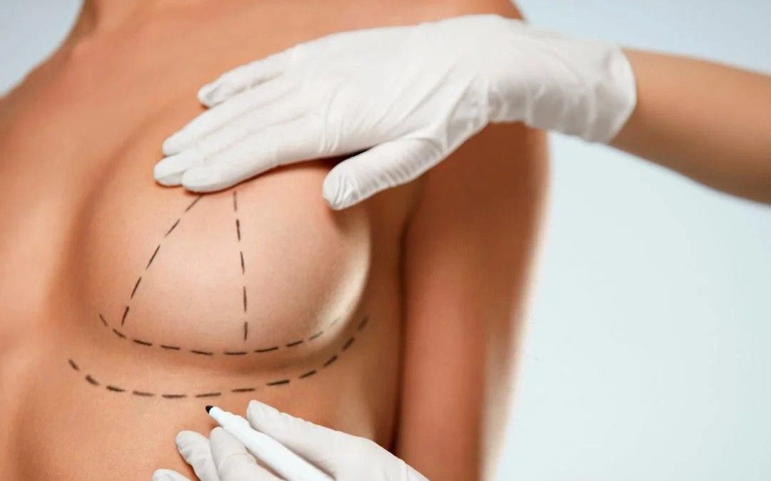 Breast Augmentation
