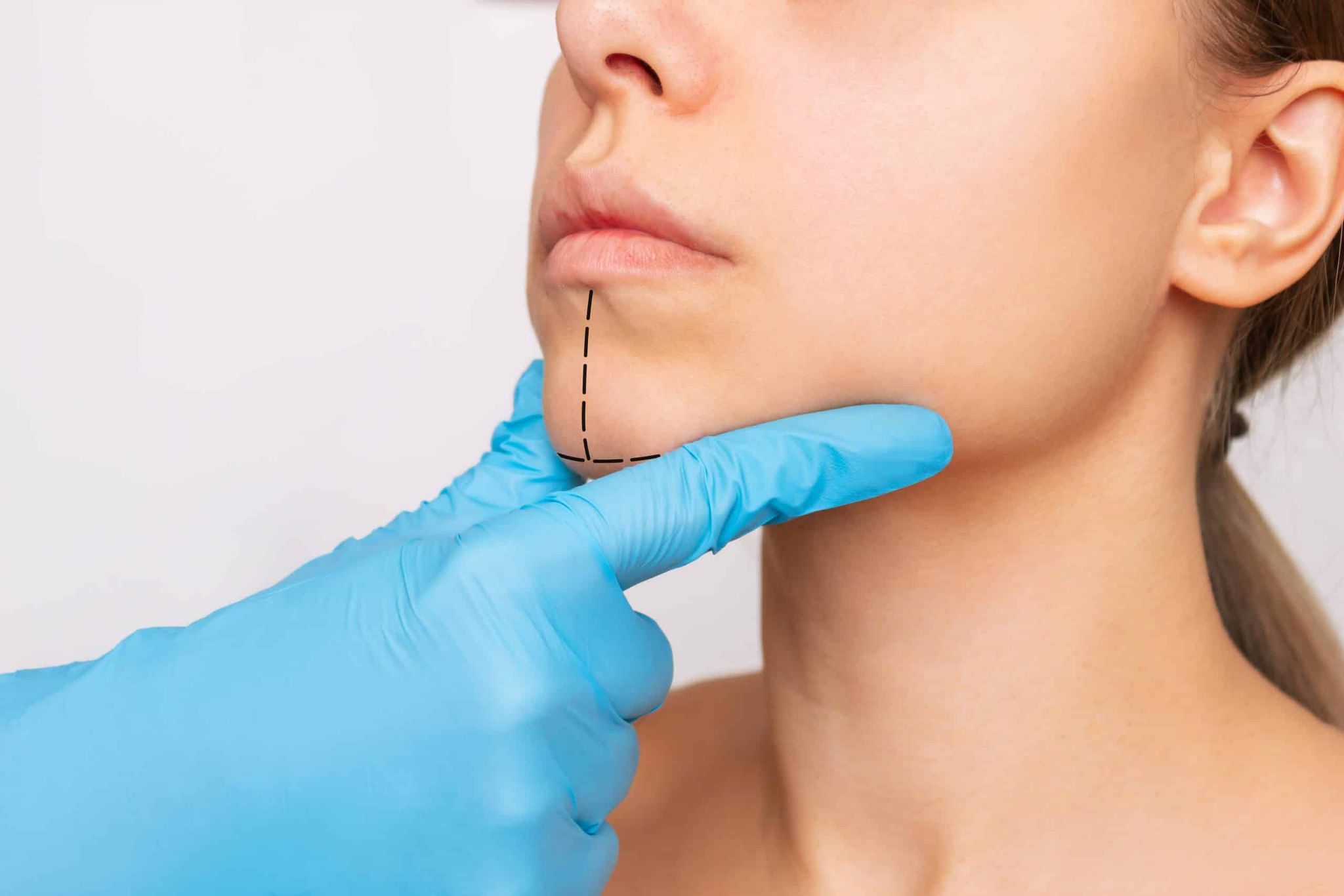 Chin Surgery
