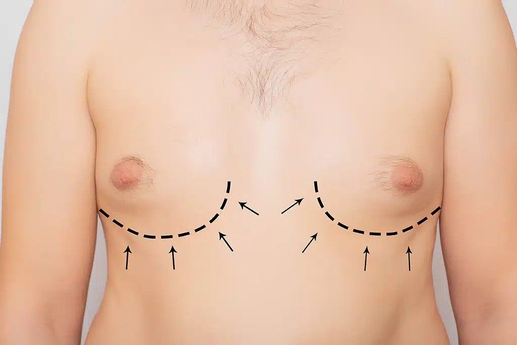 Gynecomastia