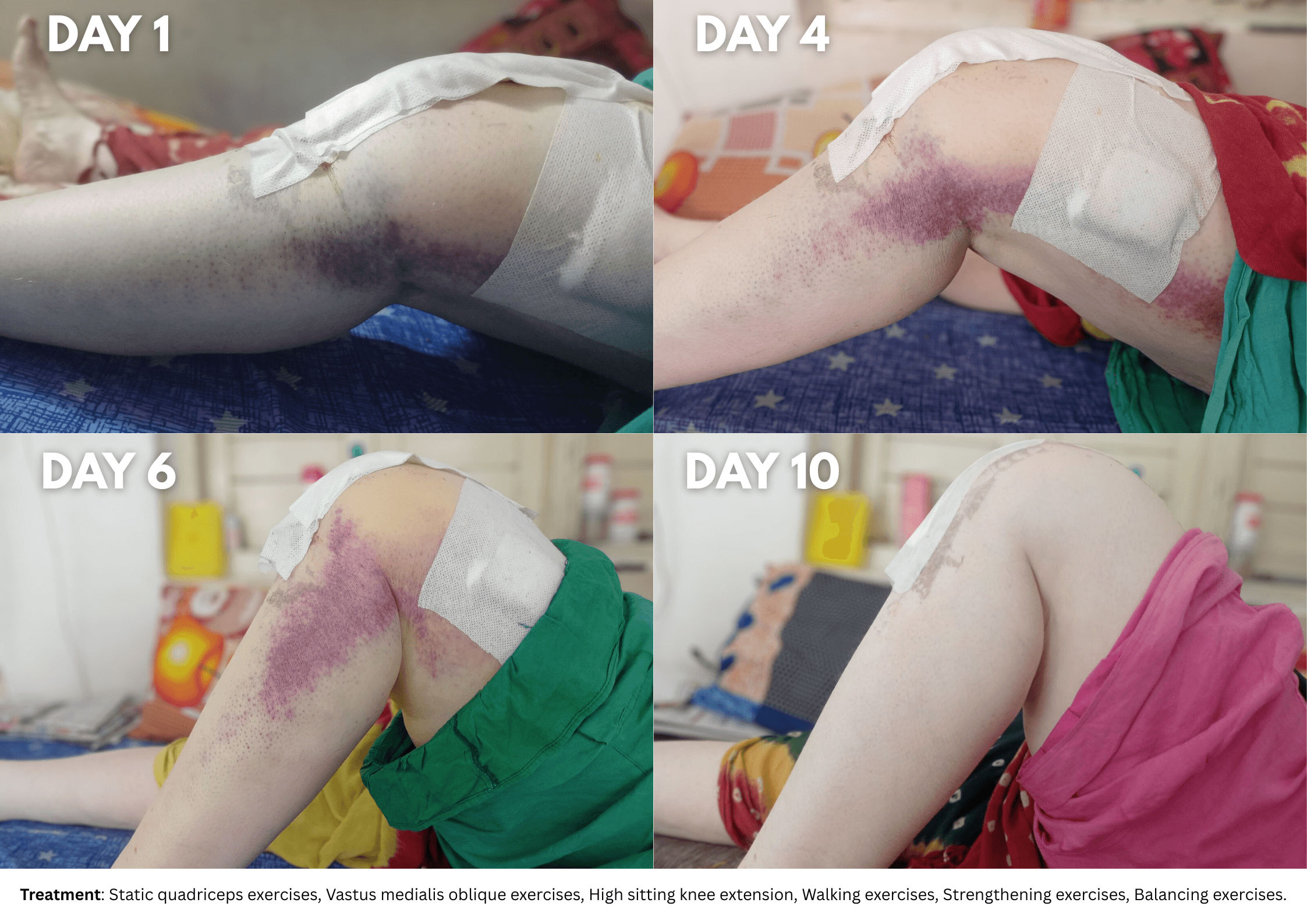 four images from day 1 to day 10, showing the progress of her leg momvement. Subtext at bottom reads - Treatment: Static quadriceps exercises, Vastus medialis oblique exercises, High sitting knee extension, Walking exercises, Strengthening exercises, Balancing exercises.